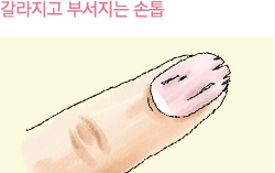 갈라지고부서지는손톱이미지