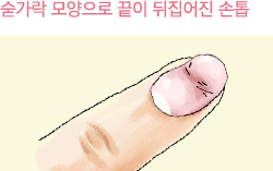 숟가락 모양으로 끝이 뒤집어진 손톱이미지