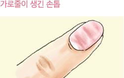 가로줄이 생긴 손톱이미지